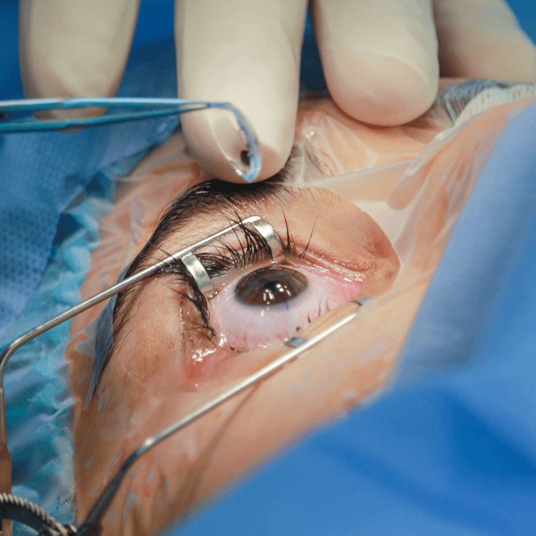 Cataract Surgery