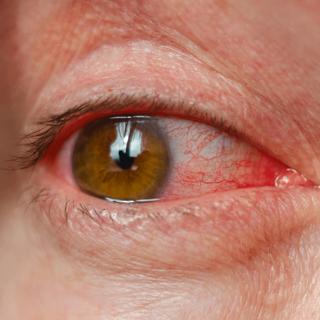 Glaucoma