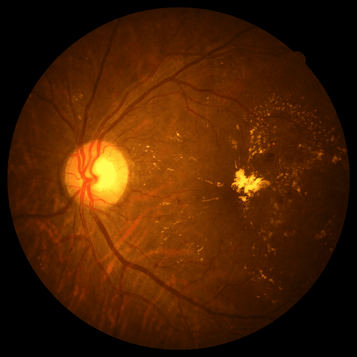 Diabetic Retinopathy